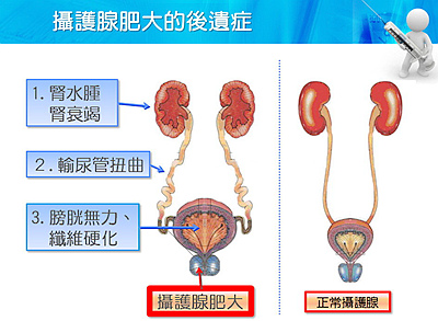 攝護腺肥大要小心後遺症