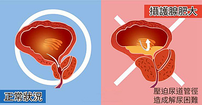 攝護腺肥大的治療與保養