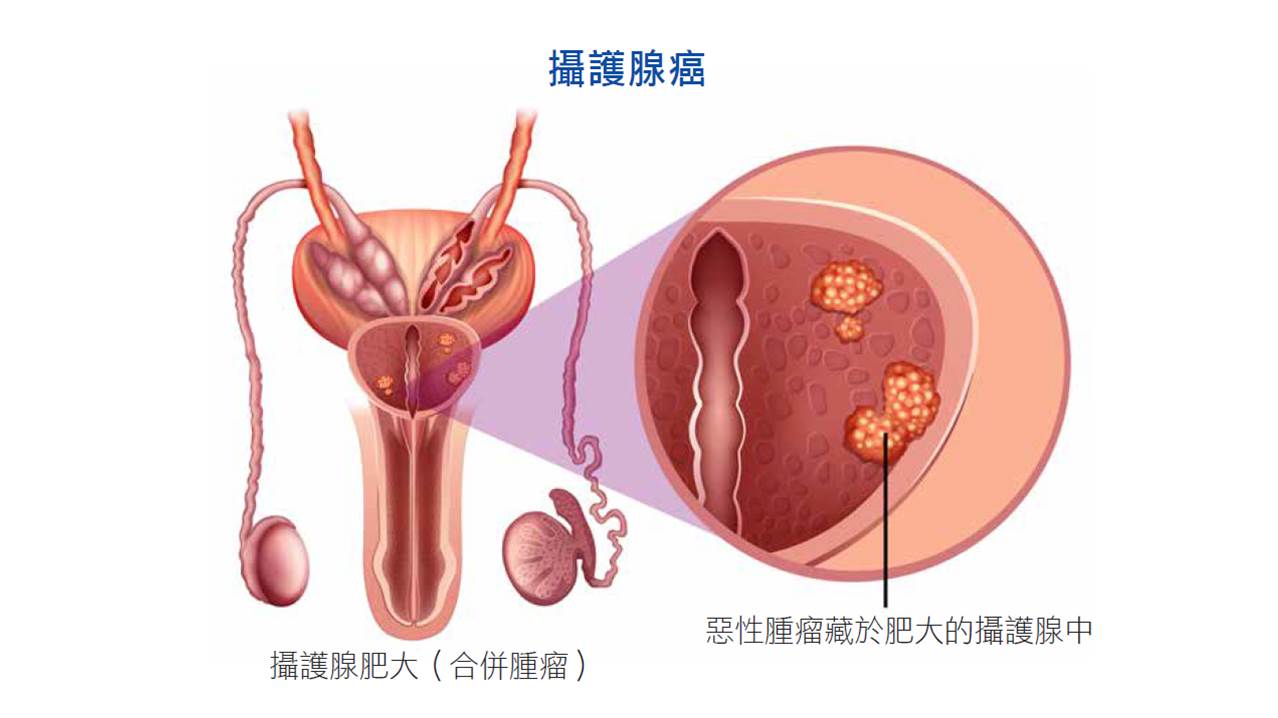 攝護腺症狀說明，攝護腺切除術後注意事項