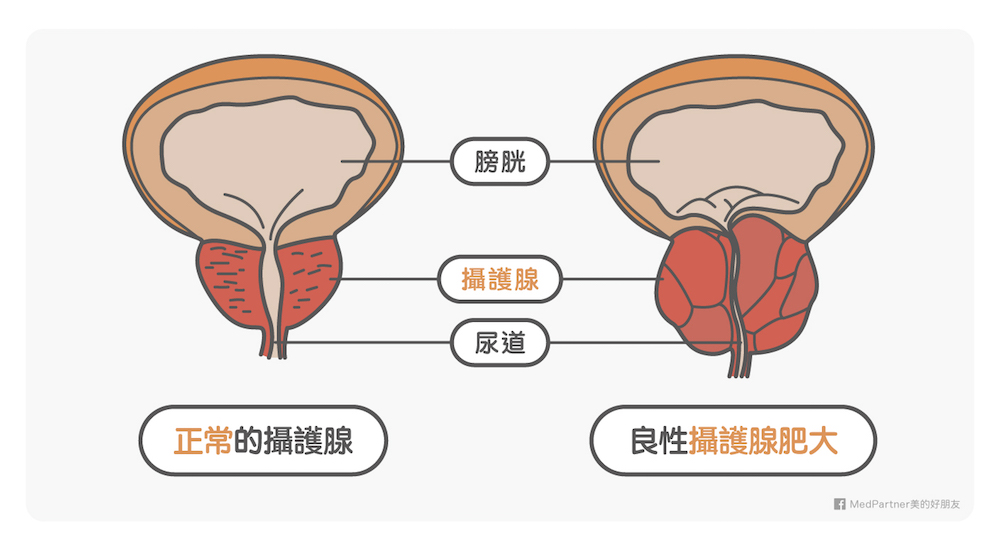 攝護腺肥大